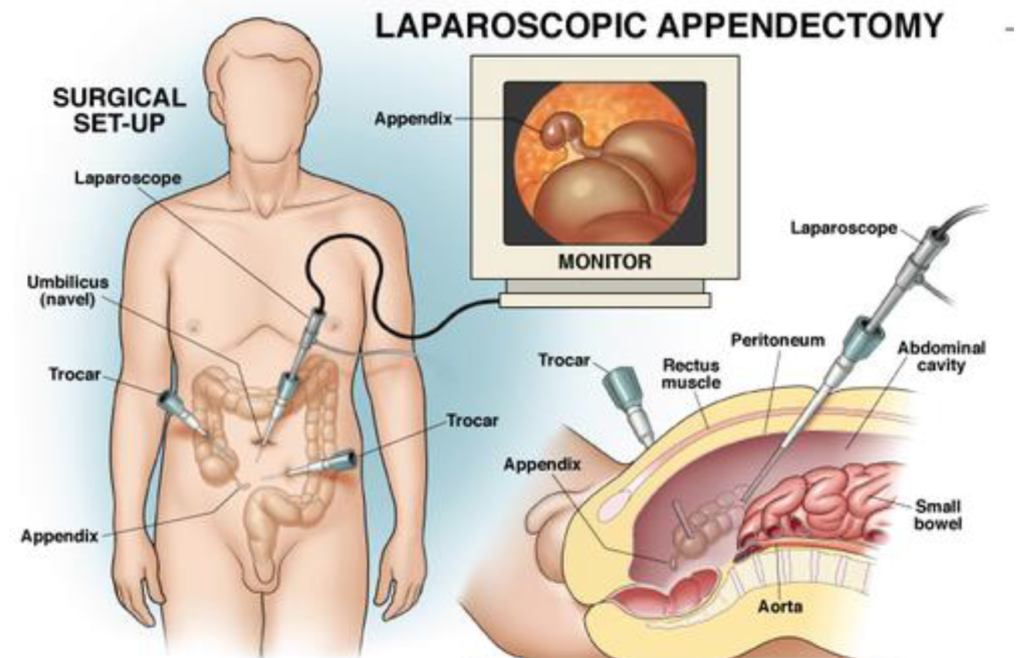 Laparoscopic Appendix Surgery